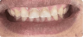 Antes